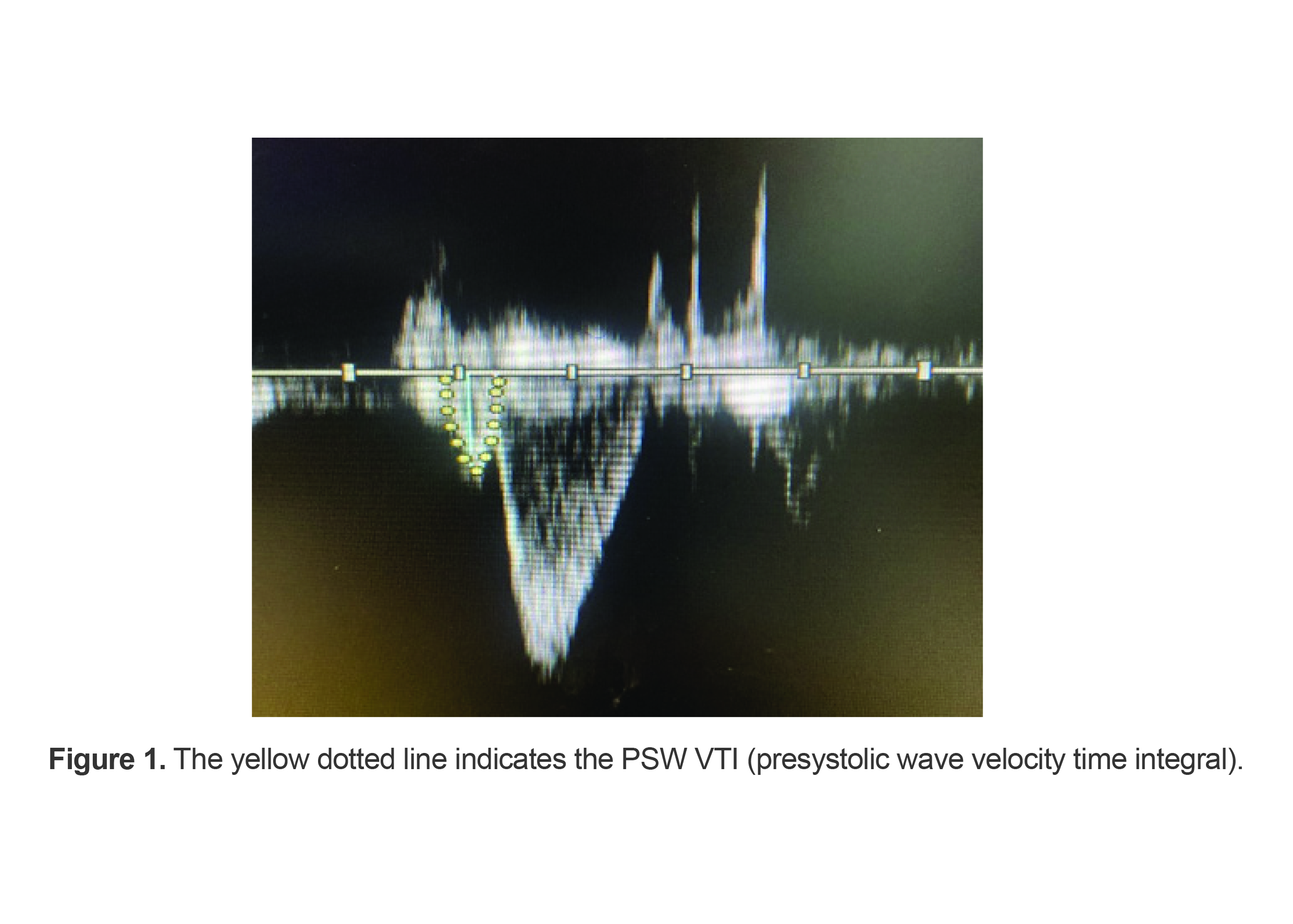 Figure 1. The yellow dotted line indicates the PSW VTI (presystolic wave velocity time integral).
