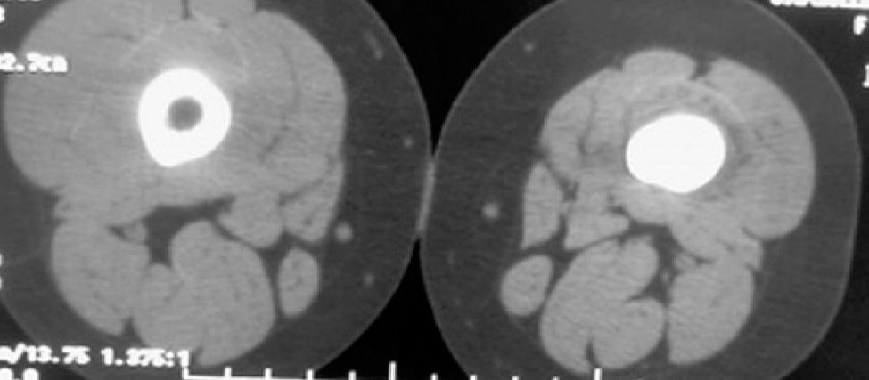 Figure 1. CT scan showing a notable sclerosis of distal diaphysis with muscular atrophic changes and mild heterogeneous density.