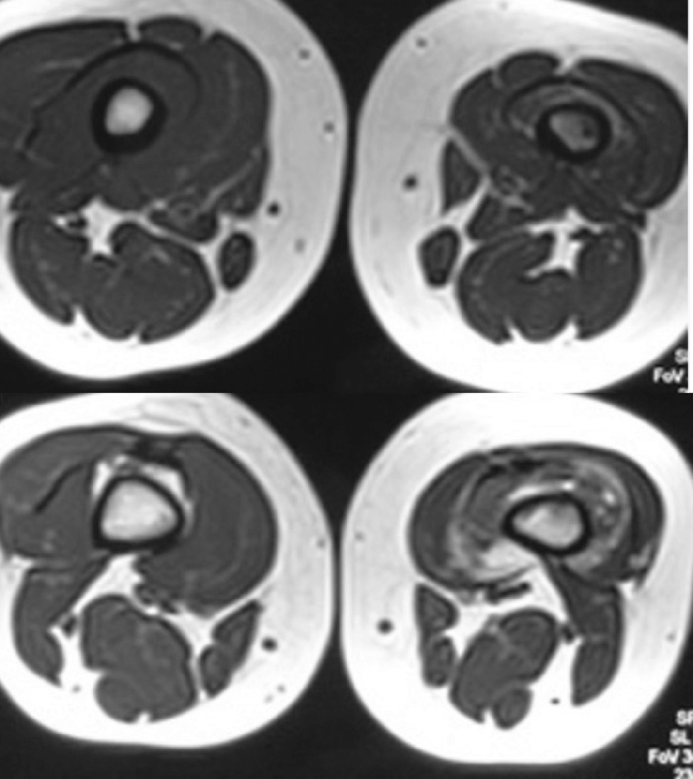 Figure 2. MRI showing a serpiginous soft tissue mass containing signal void areas with extension to knee joint with bone marrow edema and atrophy of vastus intermedius with fatty changes.  Axial T1W and T2W (a,b) and sagittal STIR  (c)  images.